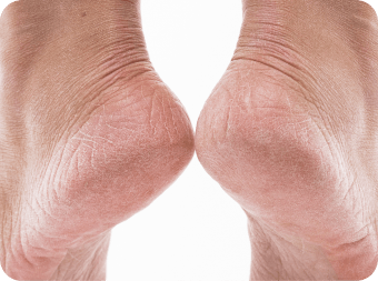 Tendinopathy